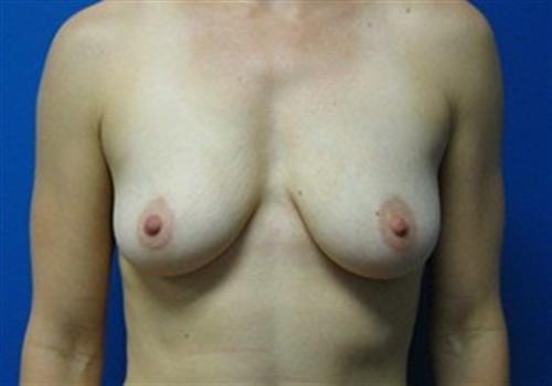 Breast Augmentation Before and After | SGK Plastic Surgery