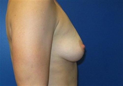 Breast Augmentation Before and After | SGK Plastic Surgery