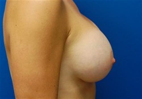 Breast Augmentation Before and After | SGK Plastic Surgery