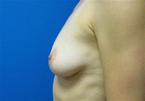 Breast Augmentation Before and After | SGK Plastic Surgery