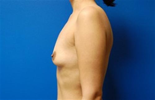 Breast Augmentation Before and After | SGK Plastic Surgery