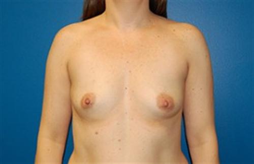 Breast Augmentation Before and After | SGK Plastic Surgery