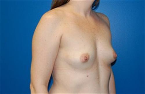 Breast Augmentation Before and After | SGK Plastic Surgery