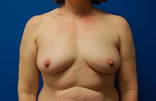 Breast Augmentation Before and After | SGK Plastic Surgery