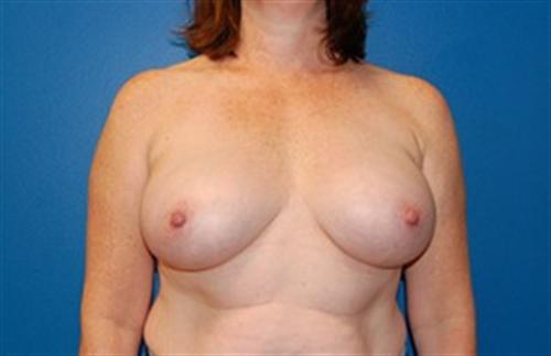 Breast Augmentation Before and After | SGK Plastic Surgery