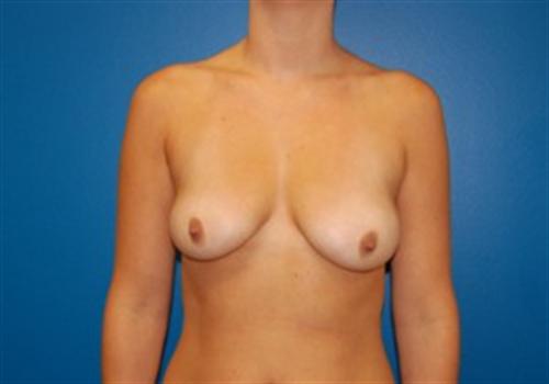 Breast Augmentation Before and After | SGK Plastic Surgery