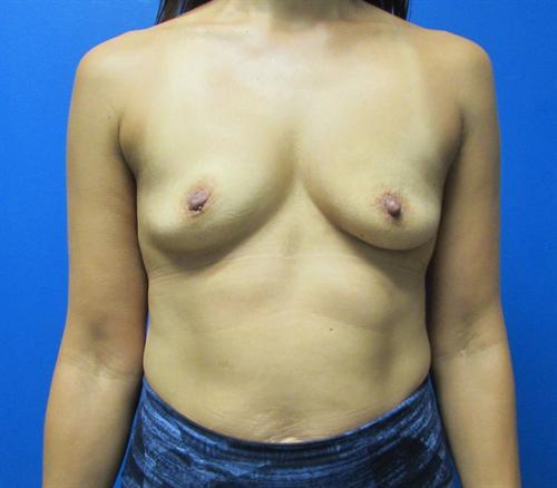 Breast Augmentation Before and After | SGK Plastic Surgery