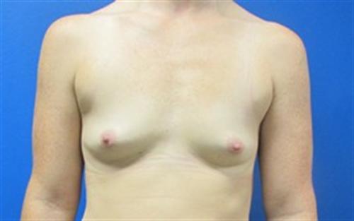 Breast Augmentation Before and After | SGK Plastic Surgery