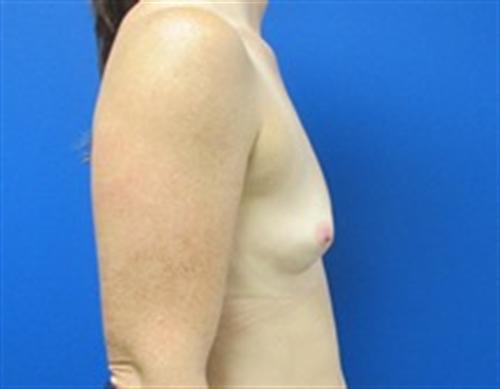 Breast Augmentation Before and After | SGK Plastic Surgery