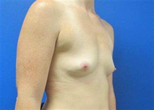 Breast Augmentation Before and After | SGK Plastic Surgery