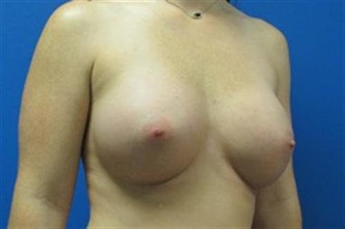 Breast Augmentation Before and After | SGK Plastic Surgery