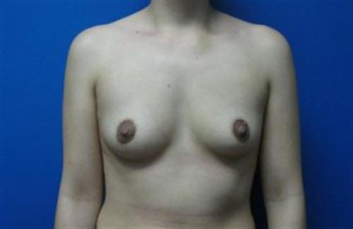 Breast Augmentation Before and After | SGK Plastic Surgery