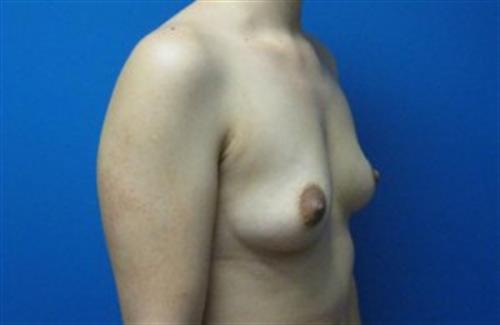 Breast Augmentation Before and After | SGK Plastic Surgery