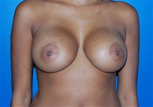 Breast Augmentation Before and After | SGK Plastic Surgery