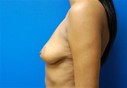 Breast Augmentation Before and After | SGK Plastic Surgery