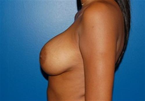 Breast Augmentation Before and After | SGK Plastic Surgery