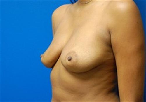 Breast Augmentation Before and After | SGK Plastic Surgery