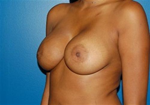 Breast Augmentation Before and After | SGK Plastic Surgery