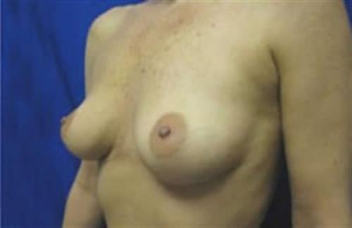 Breast Augmentation Before and After | SGK Plastic Surgery