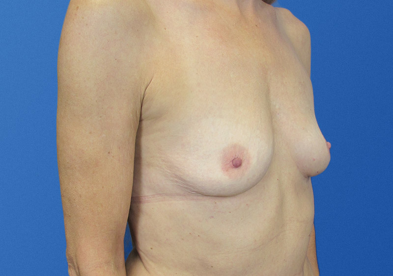 Breast Augmentation Before and After | SGK Plastic Surgery