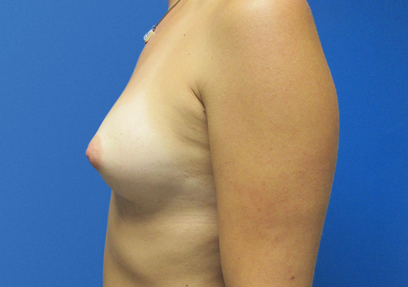 Breast Augmentation Before and After | SGK Plastic Surgery