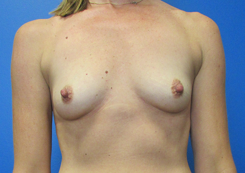 Breast Augmentation Before and After | SGK Plastic Surgery