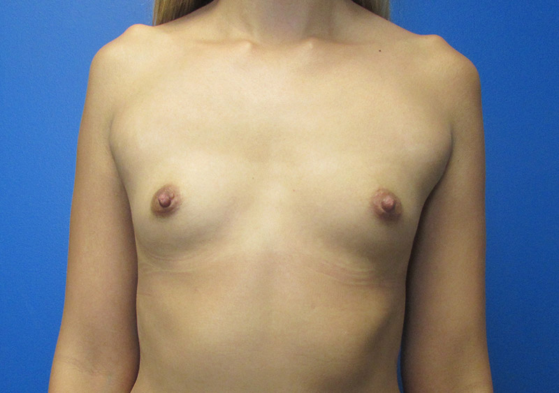 Breast Augmentation Before and After | SGK Plastic Surgery