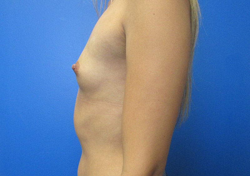 Breast Augmentation Before and After | SGK Plastic Surgery