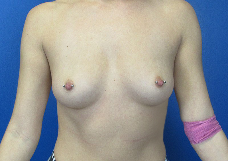 Breast Augmentation Before and After | SGK Plastic Surgery