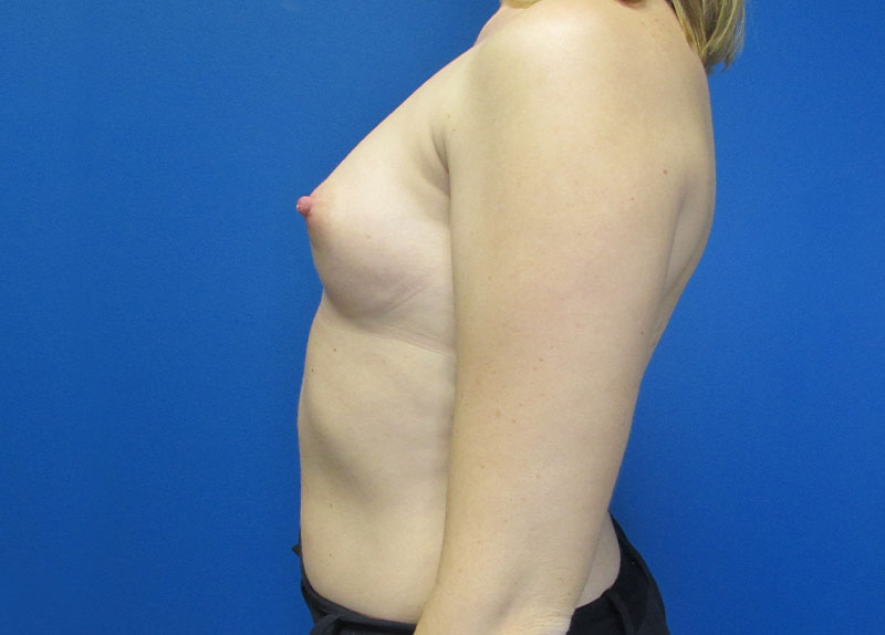 Breast Augmentation Before and After | SGK Plastic Surgery