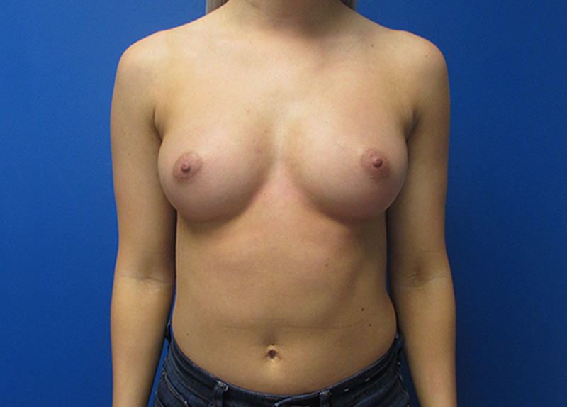 Breast Augmentation Before and After | SGK Plastic Surgery