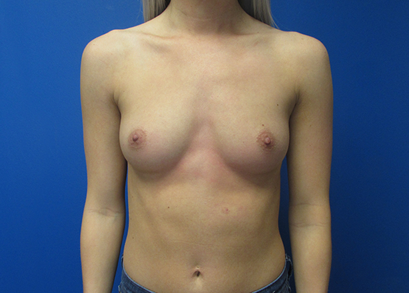 Breast Augmentation Before and After | SGK Plastic Surgery