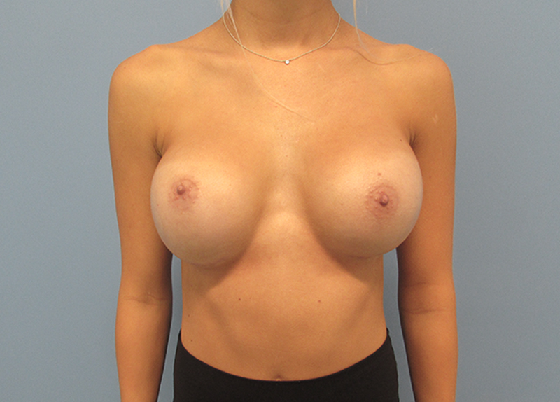 Breast Augmentation Before and After | SGK Plastic Surgery