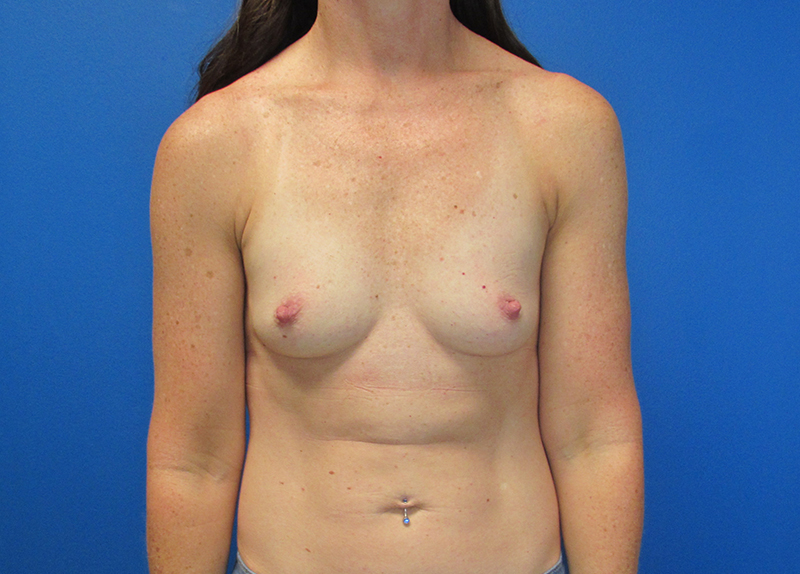 Breast Augmentation Before and After | SGK Plastic Surgery