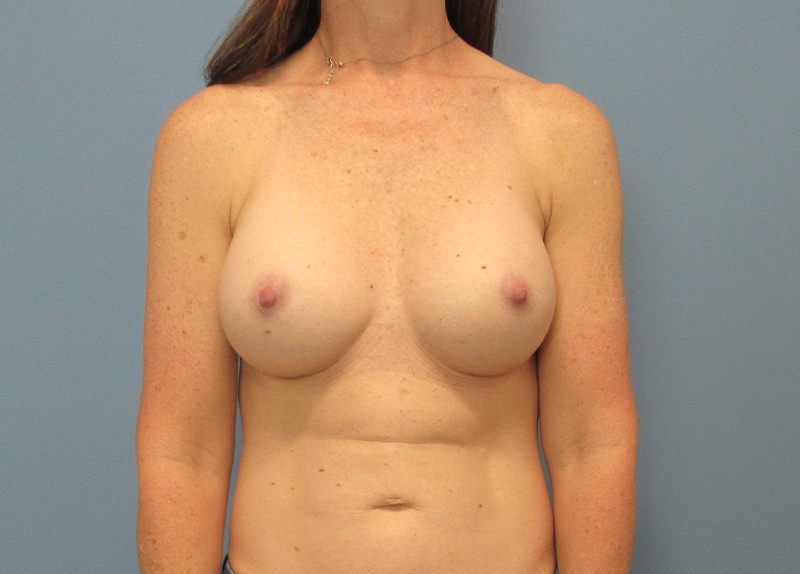 Breast Augmentation Before and After | SGK Plastic Surgery