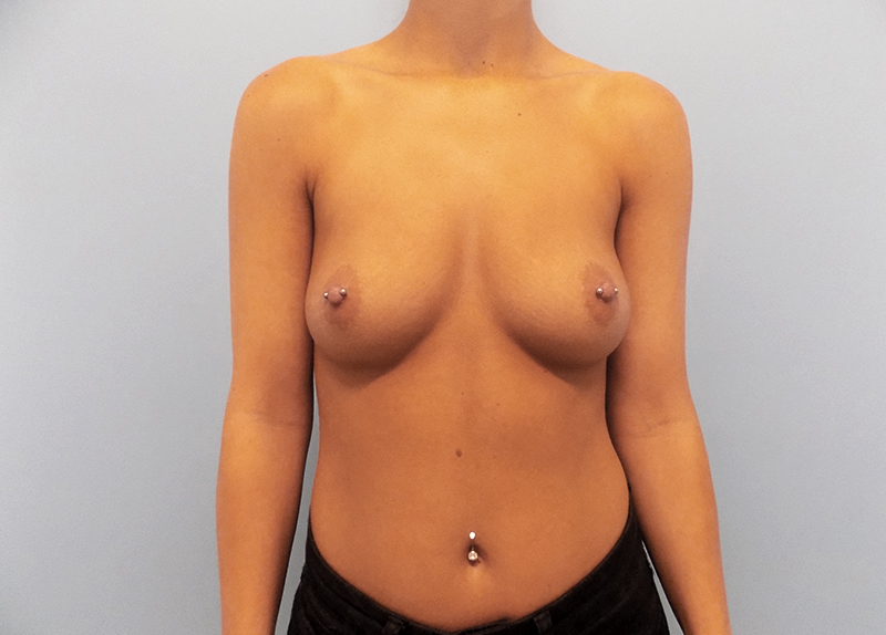 Breast Augmentation Before and After | SGK Plastic Surgery