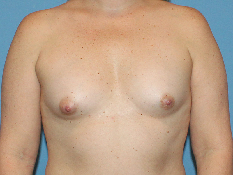 Breast Augmentation Before and After | SGK Plastic Surgery