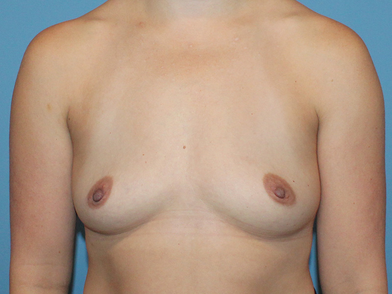 Breast Augmentation Before and After | SGK Plastic Surgery