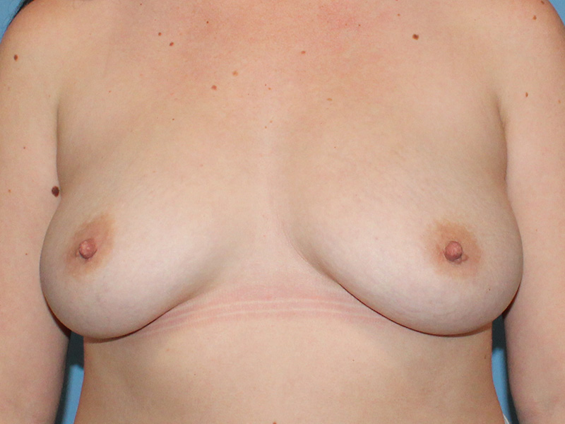 Breast Augmentation Before and After | SGK Plastic Surgery