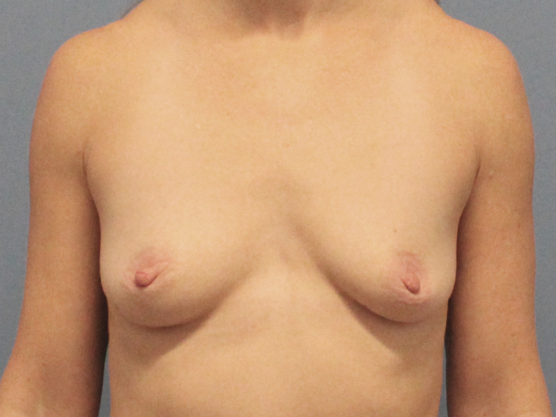 Breast Augmentation Before and After | SGK Plastic Surgery