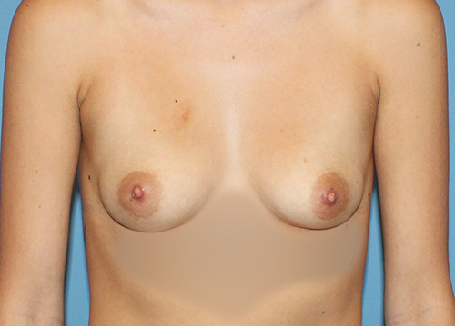 Breast Augmentation Before and After | SGK Plastic Surgery