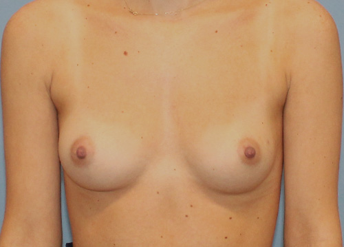 Breast Augmentation Before and After | SGK Plastic Surgery