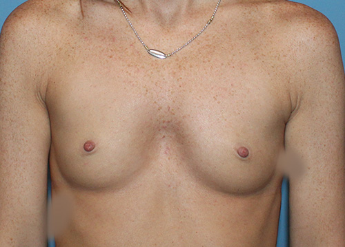 Breast Augmentation Before and After | SGK Plastic Surgery