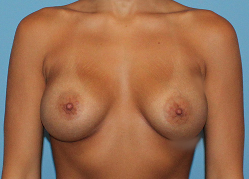 Breast Augmentation Before and After | SGK Plastic Surgery