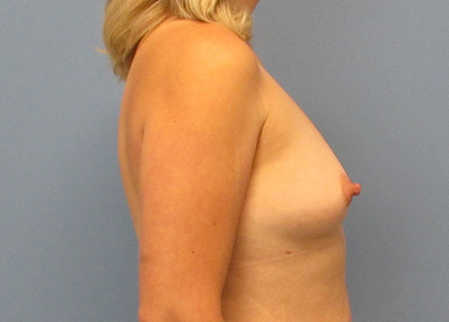 Breast Augmentation Before and After | SGK Plastic Surgery