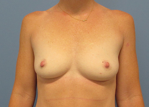 Breast Augmentation Before and After | SGK Plastic Surgery