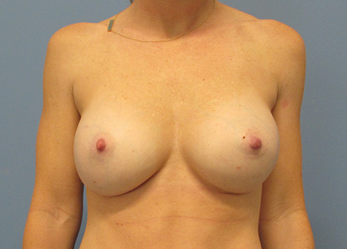 Breast Augmentation Before and After | SGK Plastic Surgery