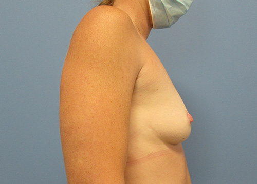 Breast Augmentation Before and After | SGK Plastic Surgery