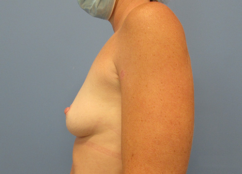 Breast Augmentation Before and After | SGK Plastic Surgery