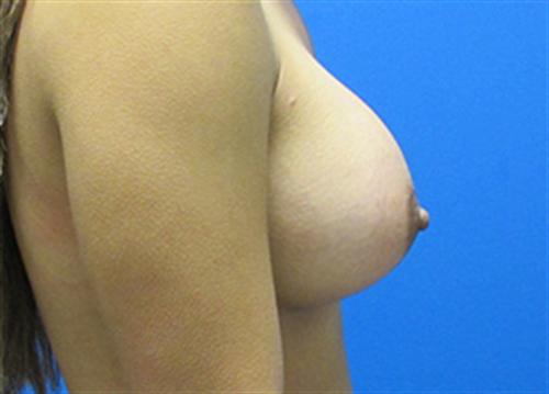 Breast Augmentation Before and After | SGK Plastic Surgery